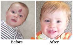 Birthmark Removal Surgeons India, Birthmark Removal Surgery Doctors India